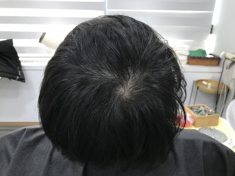 2차 시술전2.jpg