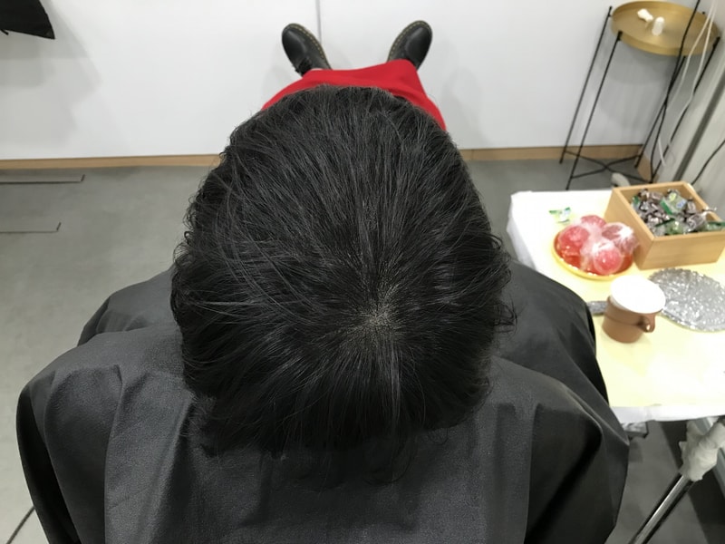 2차 시술후1.jpg