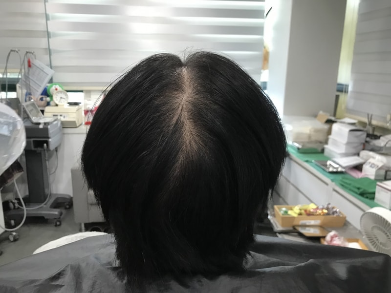 연세미다인  그라데이션 시술