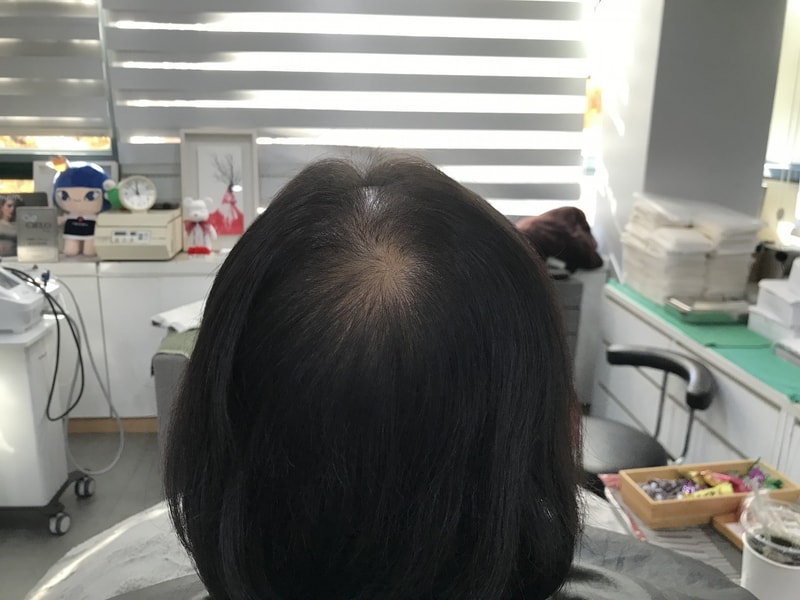[연세미다인] 두피문신