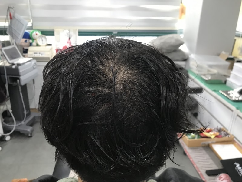 [연세미다인] 두피문신 후기