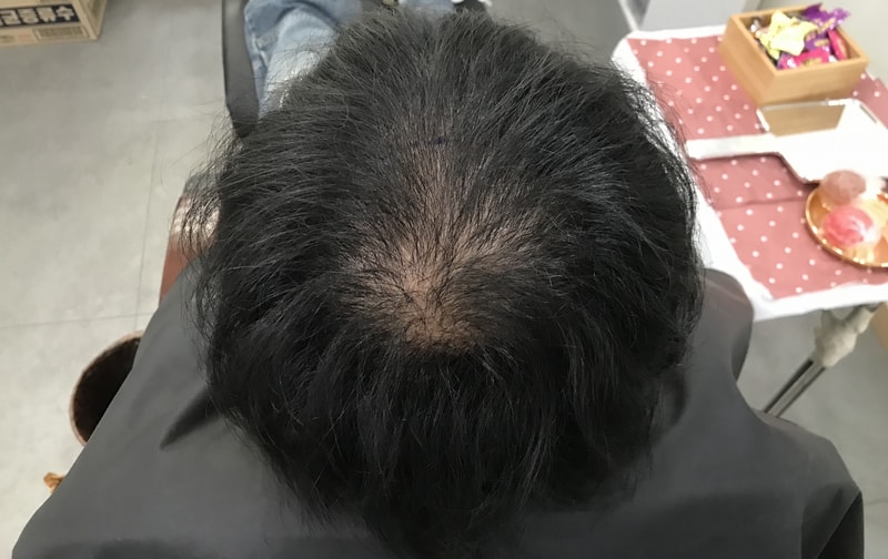 연세미다인 두피문신 후기