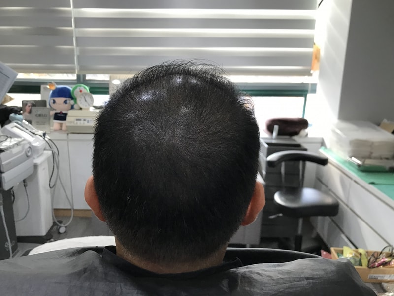 연세 미다인 성형외과 두피문신 추천합니다.