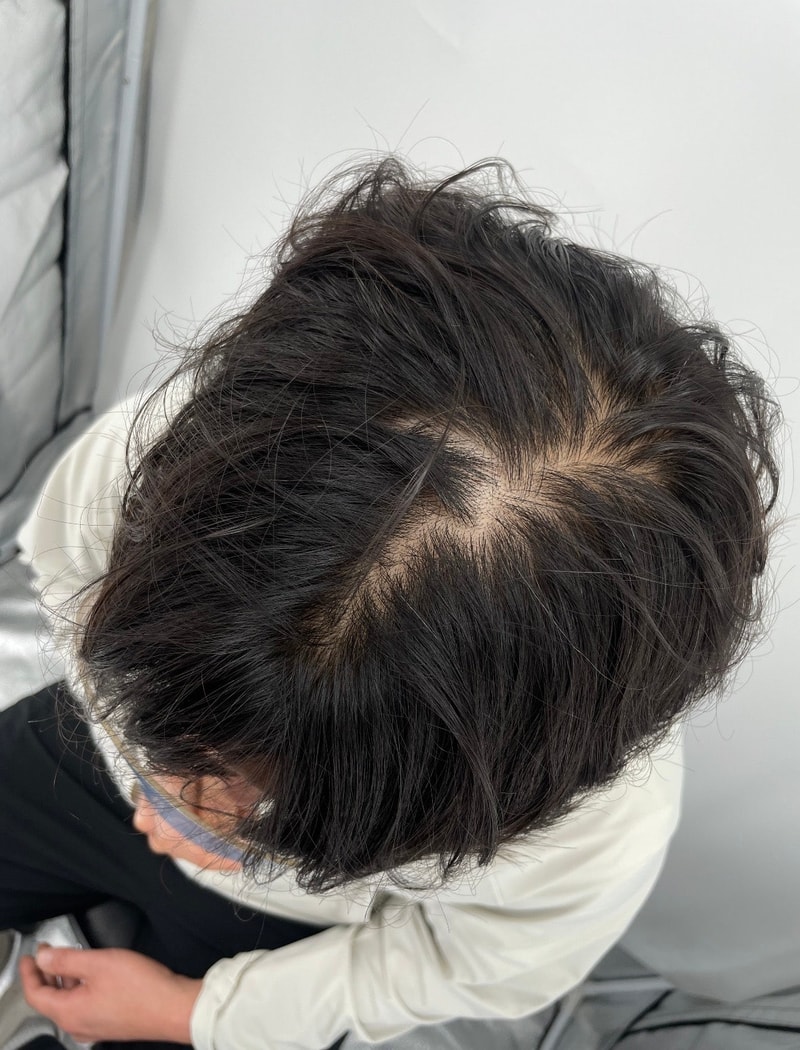뉴헤어성형외과 남성 두피문신 후기