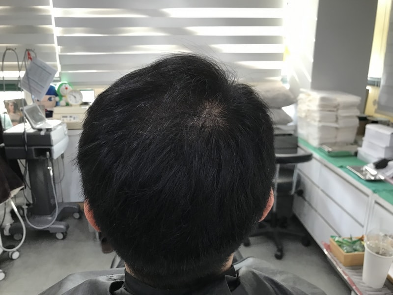 연세미다인 두피문신 시술 포토후기