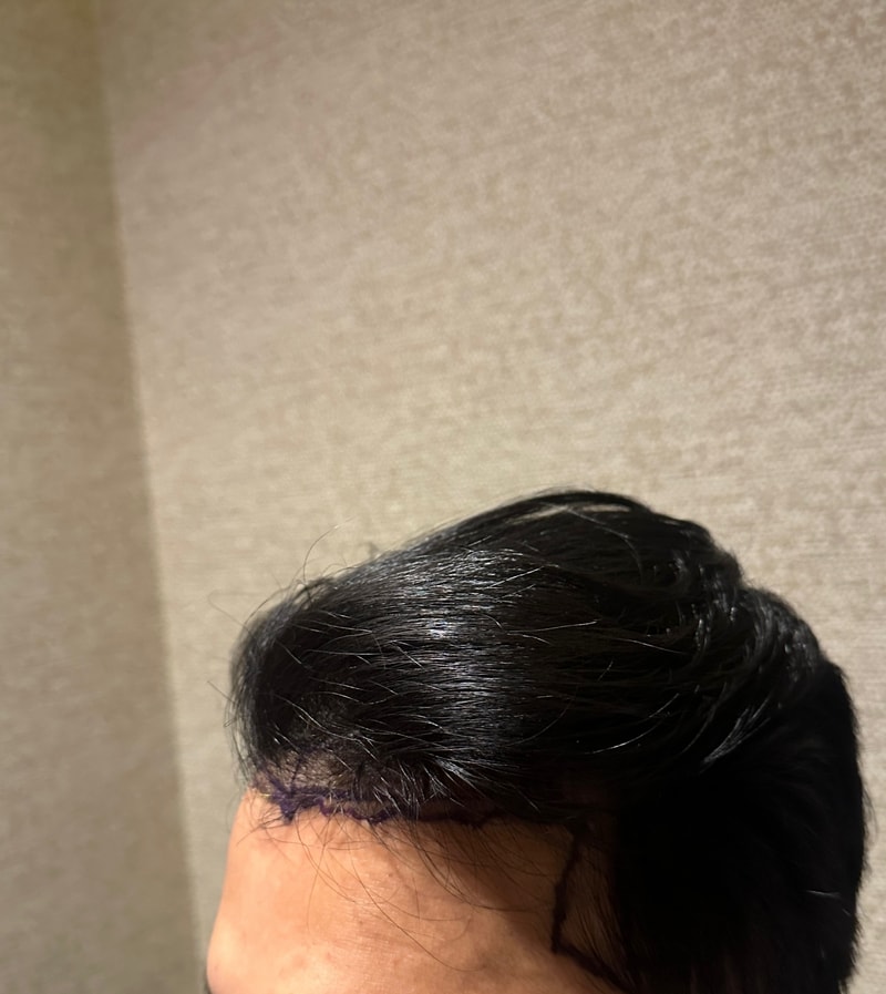 ⭐강남 뉴헤어모발 성형외과 남자 M자라인 모발이식 6일차 입니당