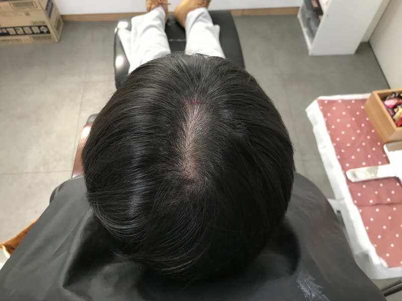 연세미다인 두피문신 후기입니다