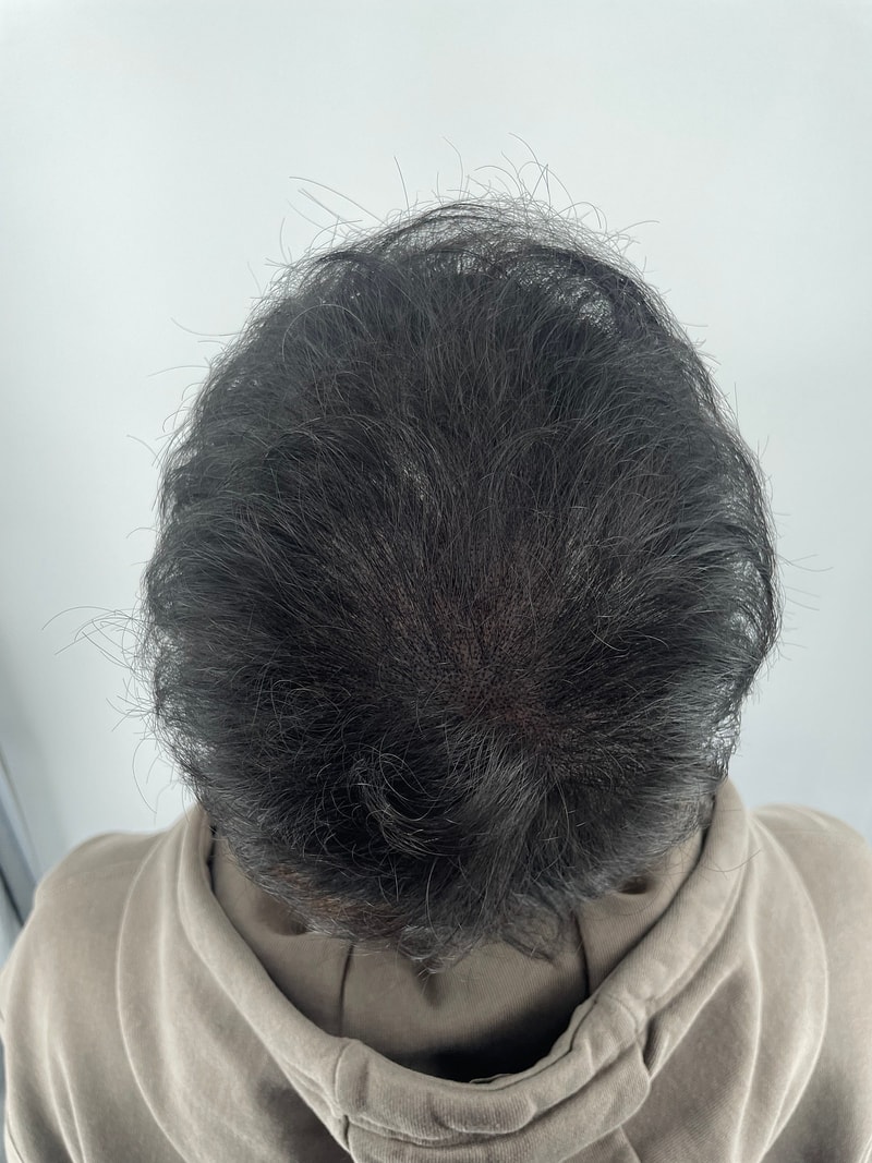 정수리 쪽이 유독 비어 보여서 늘 모자를 쓰고 다녔는데