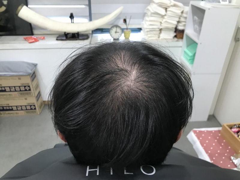 [연세미다인] 두피문신 후기
