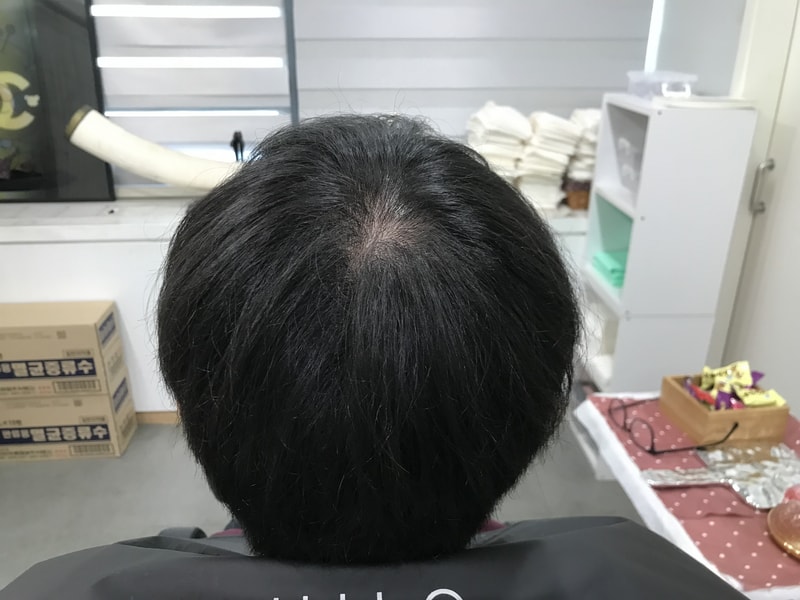 연세미다인 두피문신 1차 후기