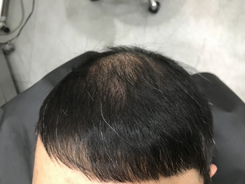 연세미다인 그라데이션 두피문신 2차 후기