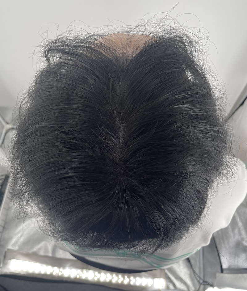 친구따라 강남 왔습니다 뉴헤어 두피문신