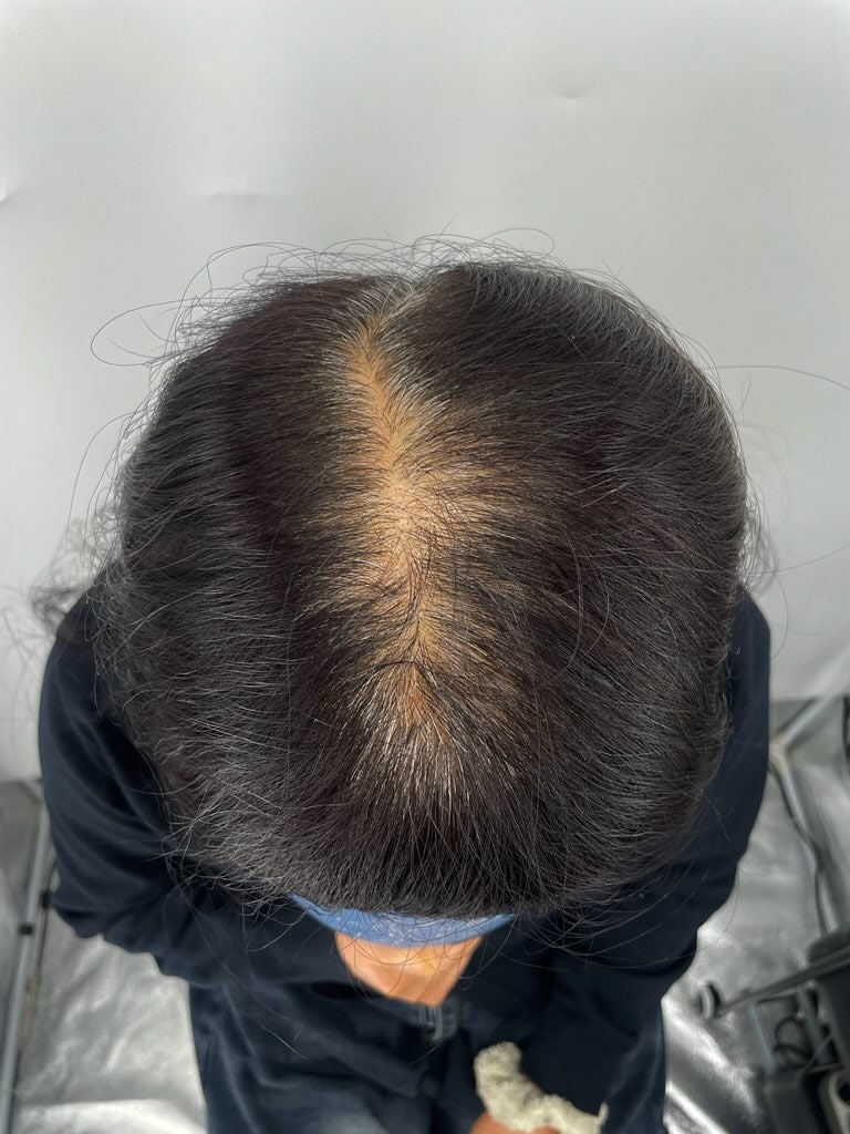 뉴헤어성형외과에서 두피문신 2차 리터치 까지 했는데