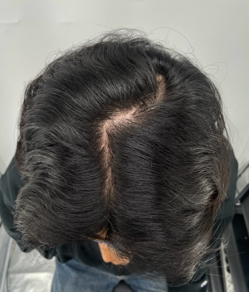 두피문신 병원 가르마 3차 후기