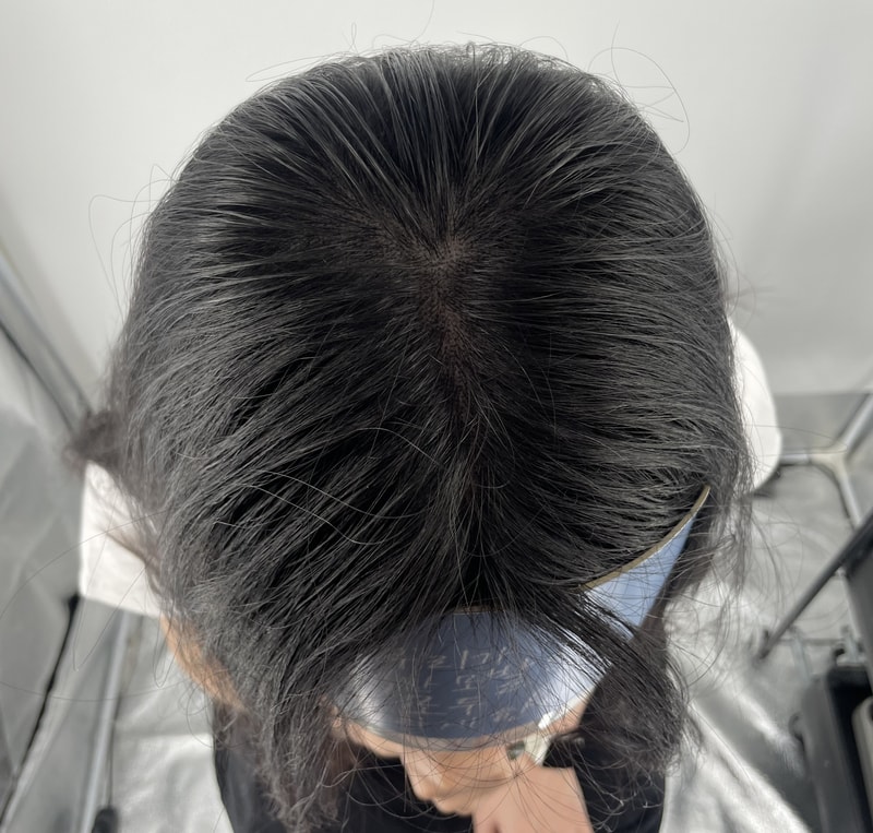 강남 두피문신병원 뉴헤어 탈모 정복기