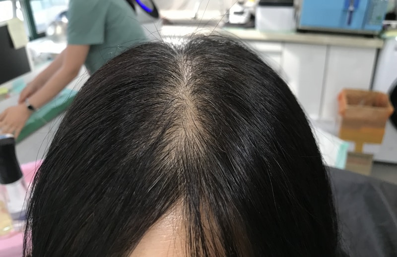 연세미다인 두피문신