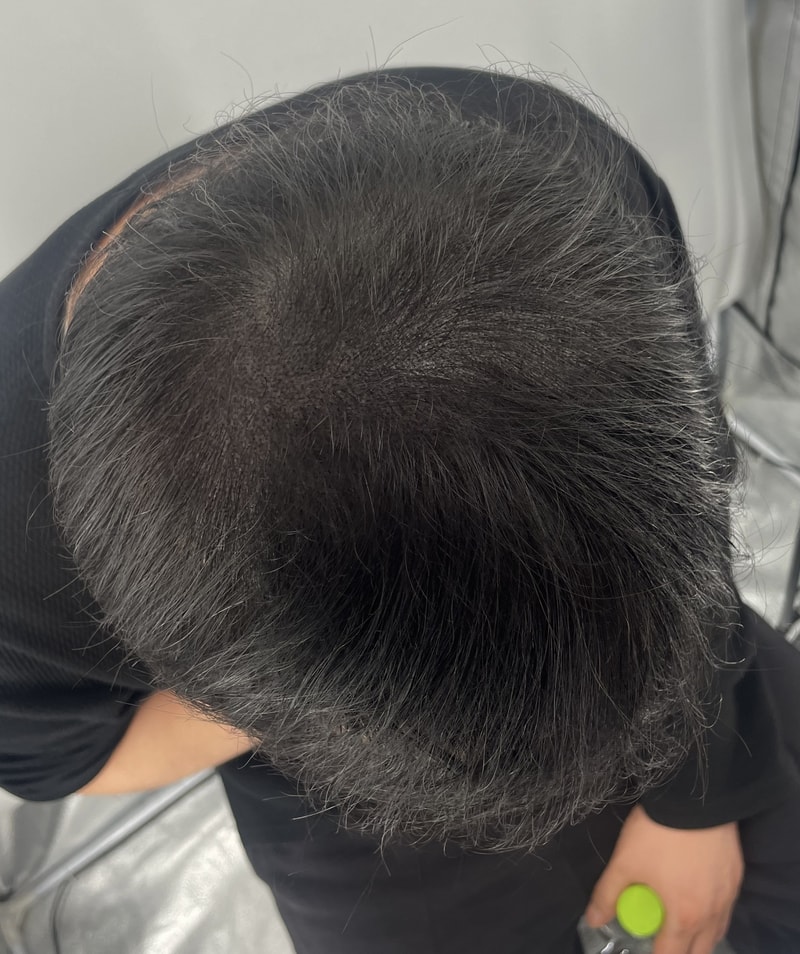 아내 권유로 두피문신 아주 잘했다