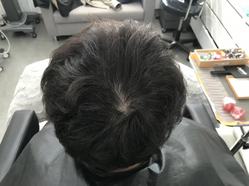 연세미다인의원 두피문신 후기