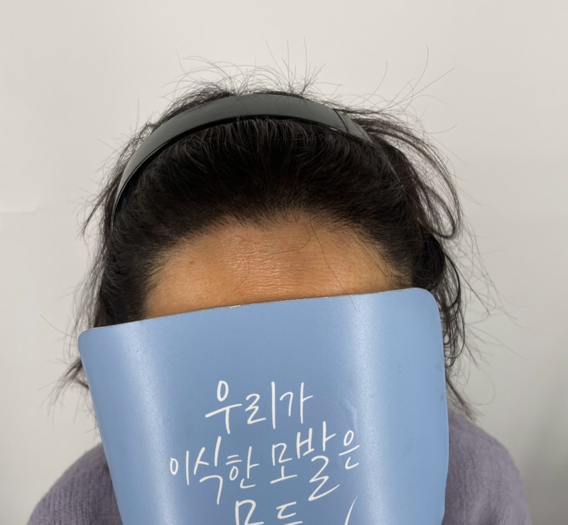 헤어라인이 점점 비어 보여서 스트레스였는데 친구 추천으로 강남 두피문신 병원 알아보다가 뉴헤어에서 시술 받게 됐어요. 