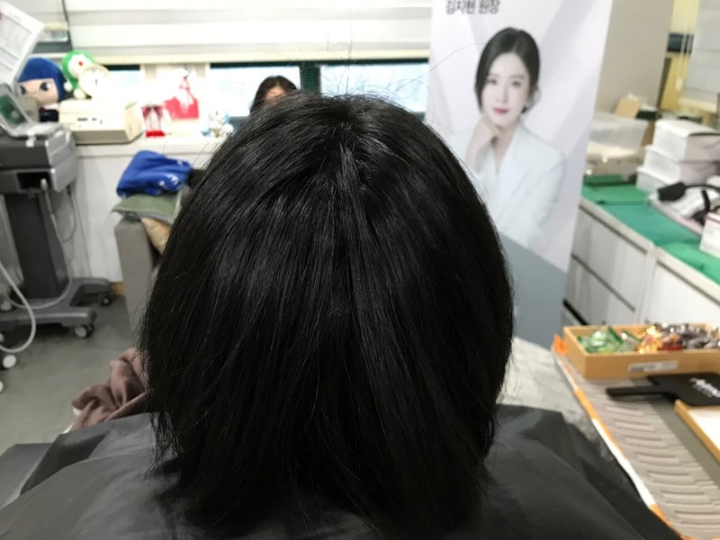 [연세미다인] 두피문신 1차 후기