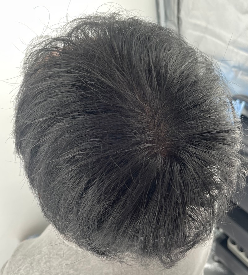 강남 두피문신 유명 병원 뉴헤어에서 받았습니다