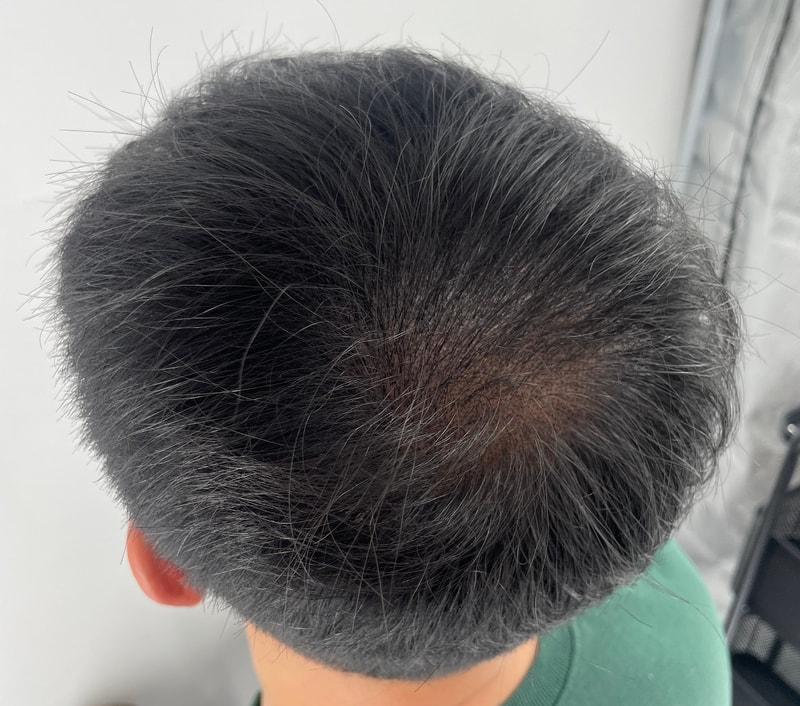 정수리 두피문신 2회차 (아직 한 번 더 남음)