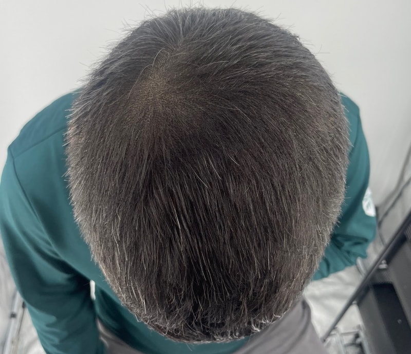 50대 두피문신 많은 고민 후 선택했습니다 찐