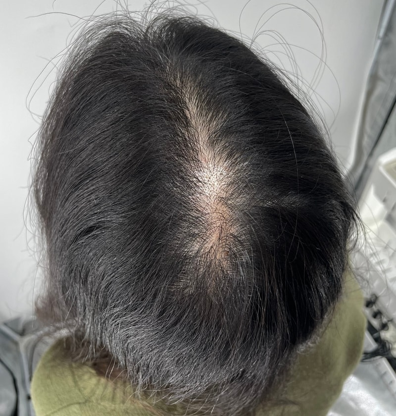 흑채 탈출! 거짓 없는 후기 강남 두피문신 탑 병원 뉴헤어모발성형외과