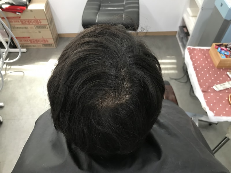 연세미다인 두피문신 후기