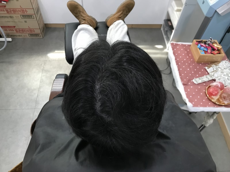 연세미다인 두피문신 6개월 후 as리터치