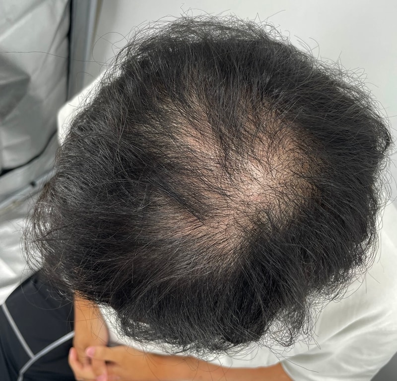 어버이날 두피문신 선물해드리기! 강님 뉴헤어 어버이날 이벤트 두피문신 후기