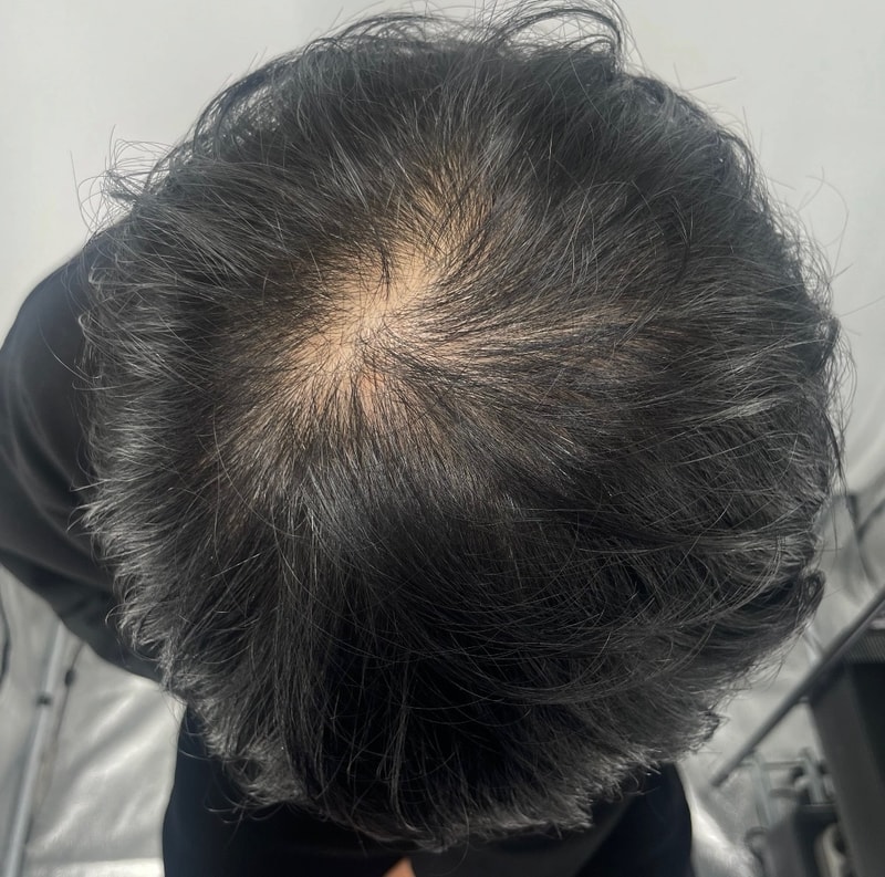 뉴헤어 두피문신 3차 후기 대만족
