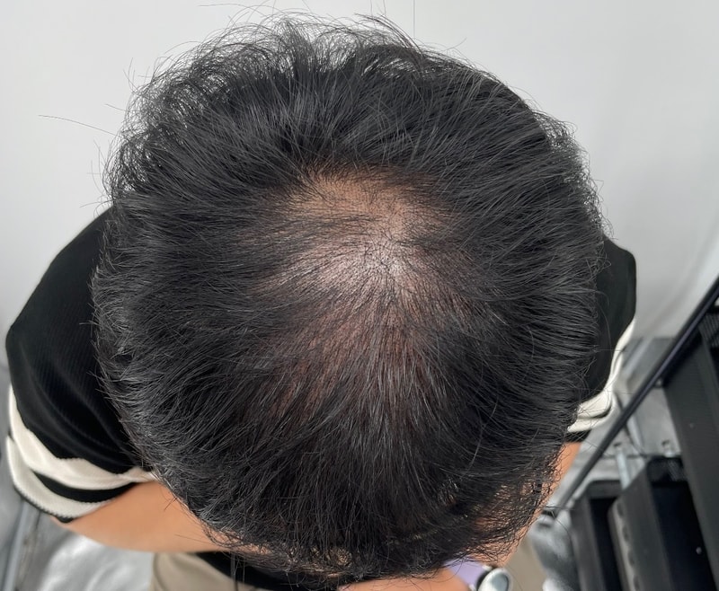 유튜브에서 두피타투 검색 중 강남에 유명한 뉴헤어성형외과에 방문하게 되었습니다.