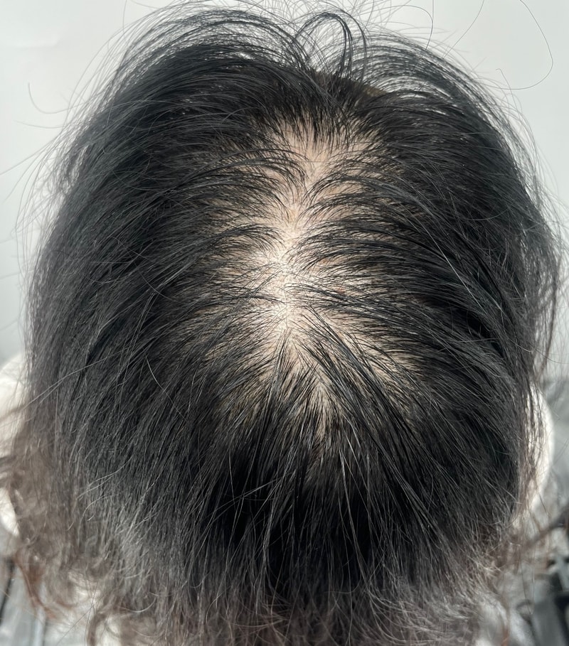 두피문신하고 흑채 버렸습니다!!