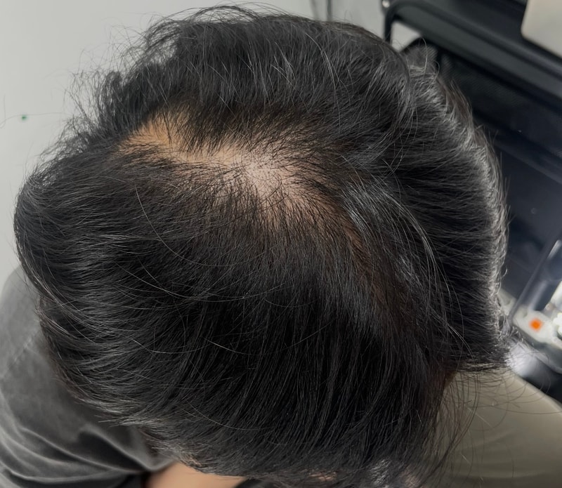 DAEDAMO看完后记选择的江南NEWHAiR 植发中心头皮纹身后记