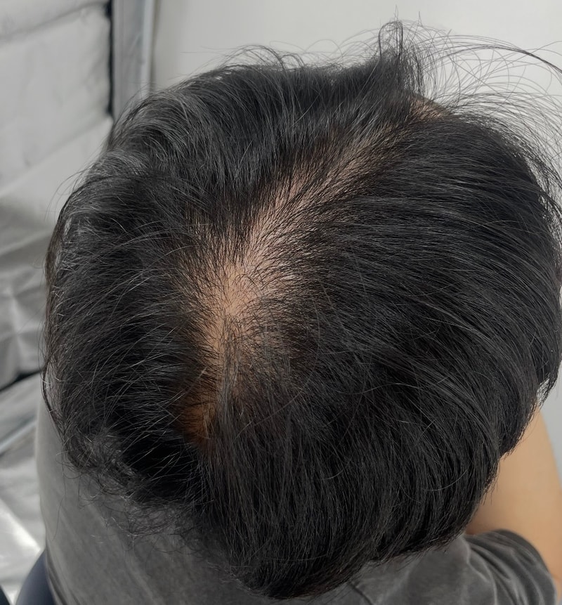 跟着朋友去江南NEWHAiR 植发中心头皮纹身了