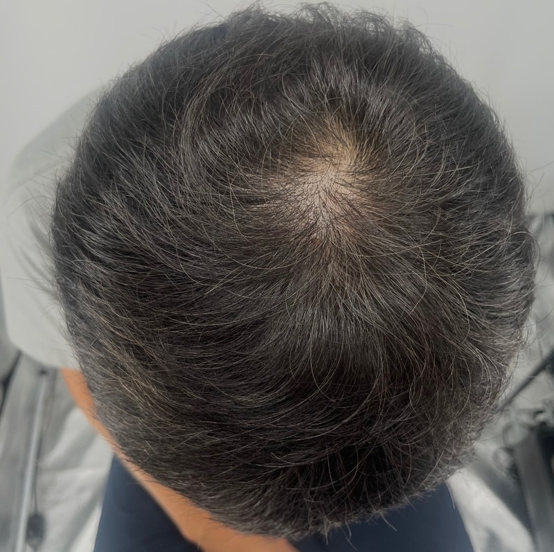 下定决心在江南NEWHAiR 植发中心做了头皮纹身。