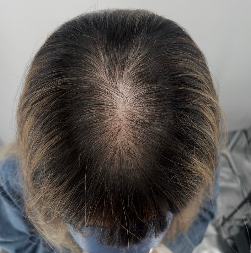 DAEDAMO后记报告 江南NEWHAiR 植发中心头皮纹身（2集 后记） 还剩1次