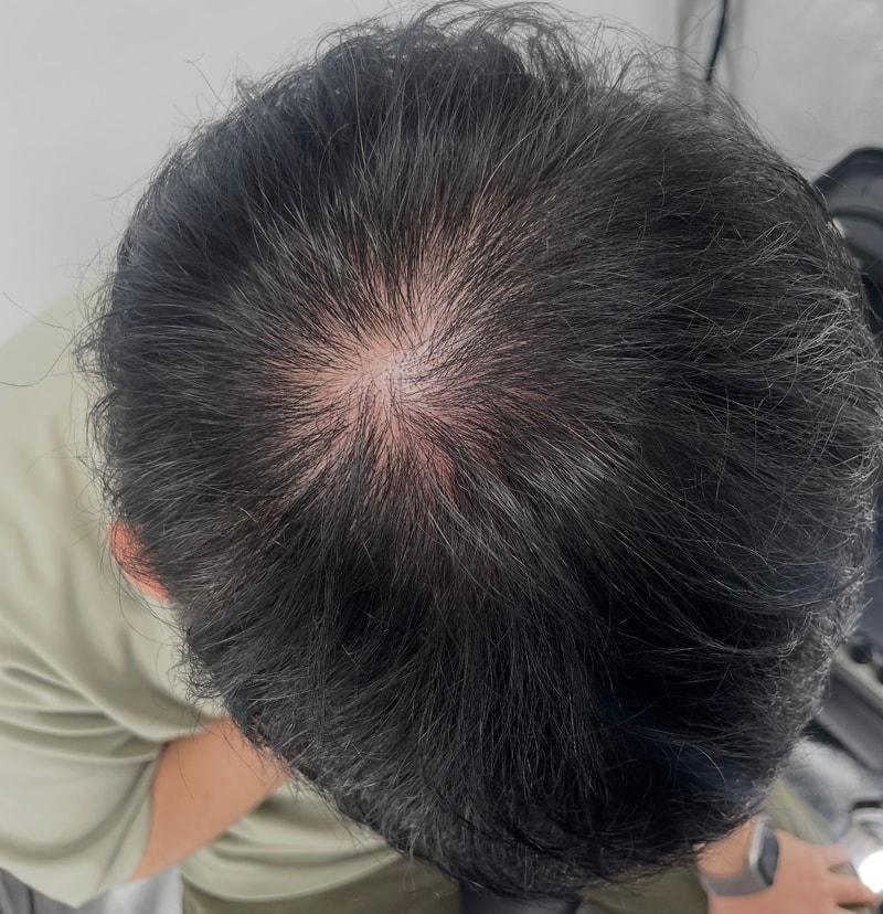 江南NEWHAiR 植发中心头皮纹身！ 因为稳定性和专业性 从釜山来的