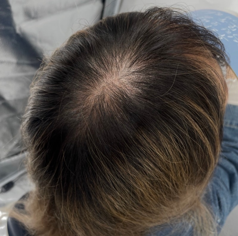 上次上传了第2次后记，这次完成了第3次（江南头皮纹身NEWHAiR 植发中心）