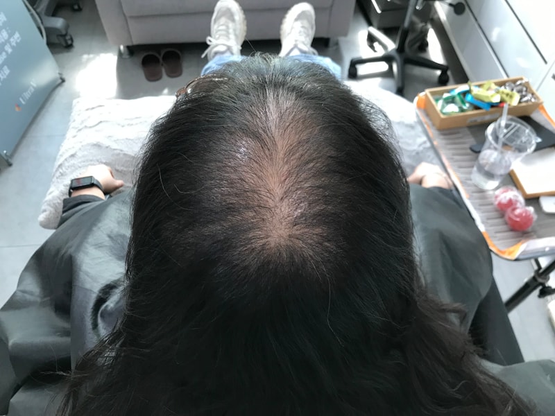 [Yonsei Midain Clinic]头皮纹身后期