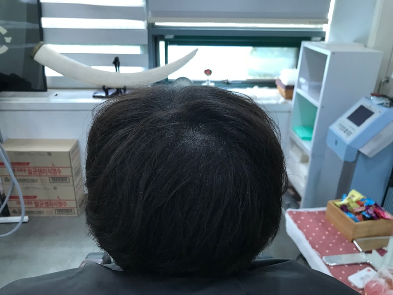 [Yonsei Midain Clinic] 纹头皮 2集 后记