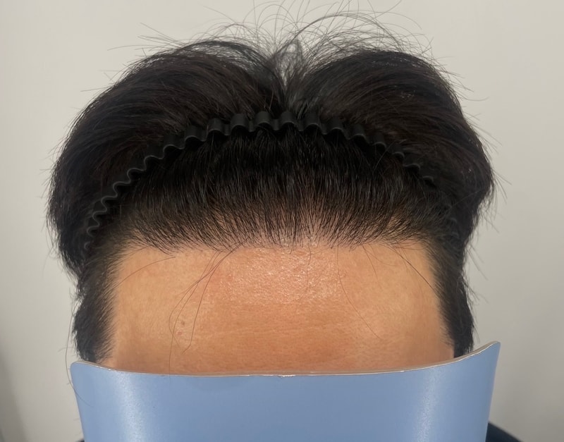 毛发移植后为了填满不足的密度而苦恼,在江南NEWHAiR 植发中心头皮纹身(SMP)