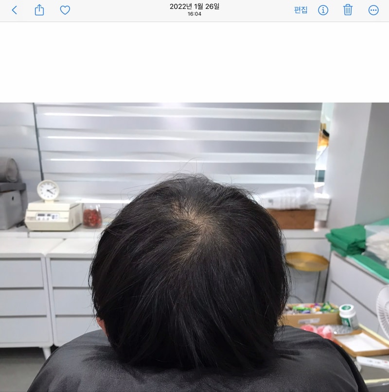 Yonsei Midain Clinic纹头 4年后期