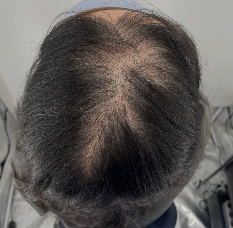 终于摆脱假发！ 严重脱发的人也推荐江南NEWHAiR 植发中心头皮纹身。