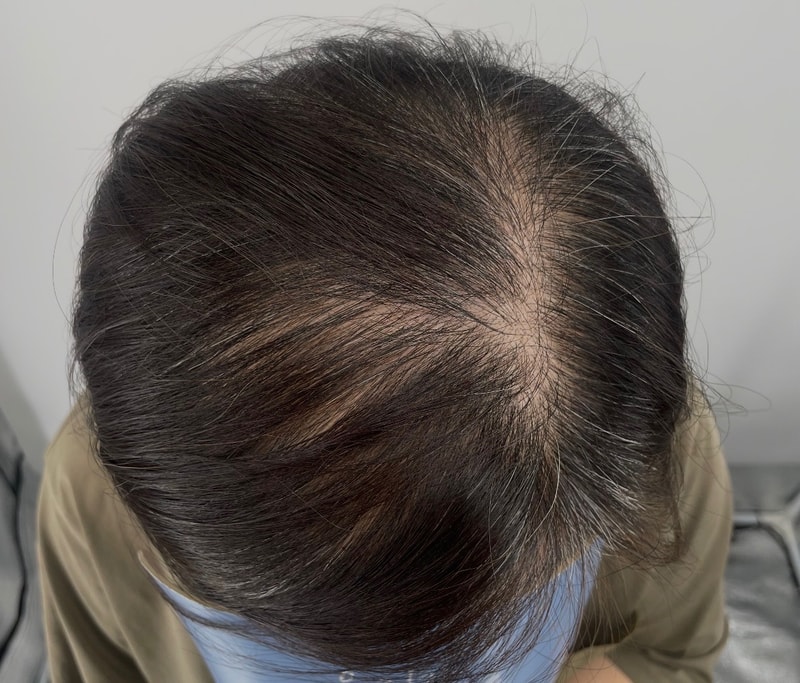 我每次出门都用黑发，刮风天我特别在意，我下狠心在江南NEWHAiR 植发中心做了个头皮纹身。