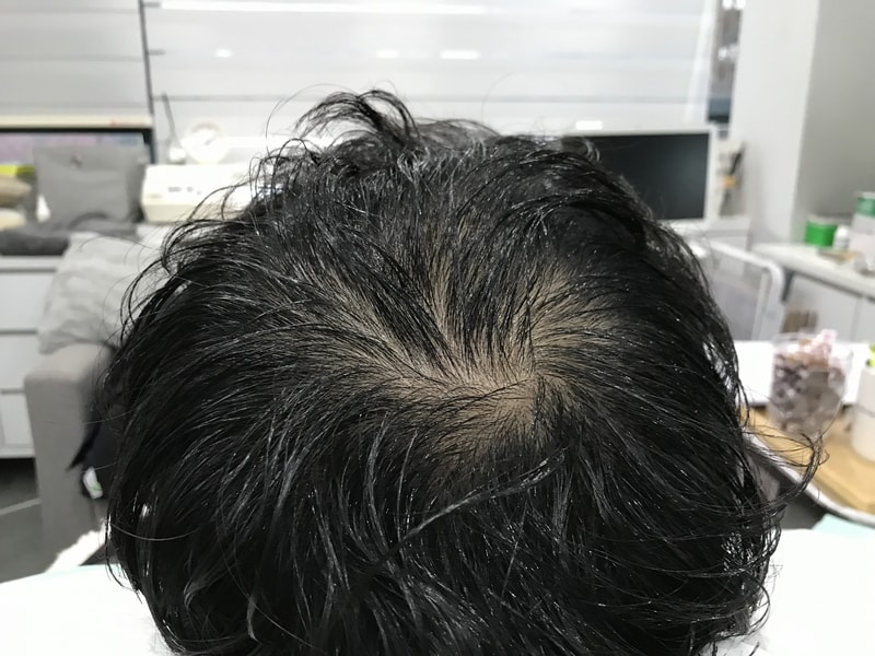 연세 미다인 두피문신 1년후기