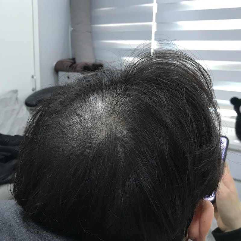 2차 시술 전 3.jpg