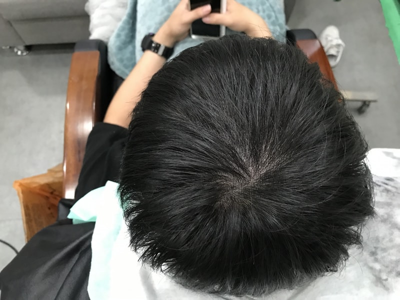 시술후 물안묻은 상태.jpg