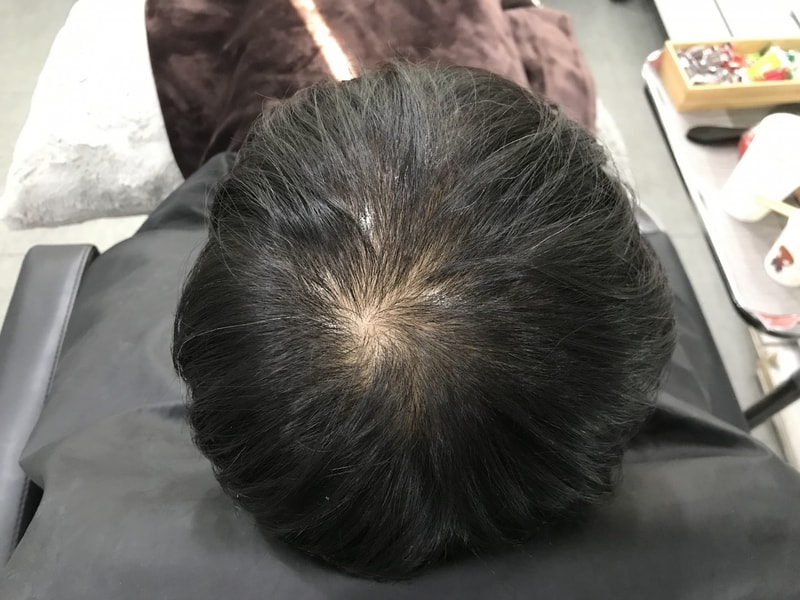 정수리 두피 문신 1차 후기